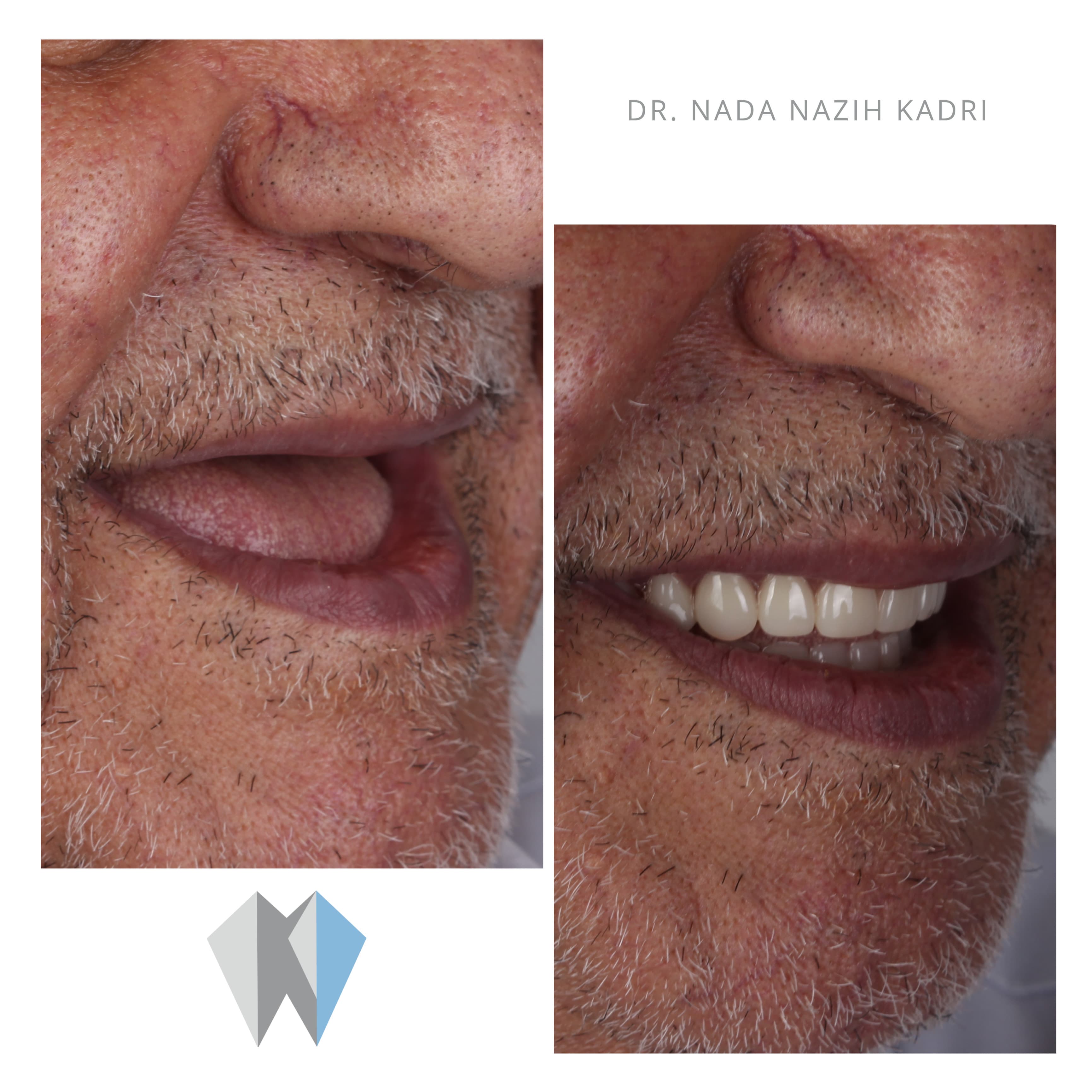 Before and after photos showing a man's smile transformation from toothless to full dental restoration.