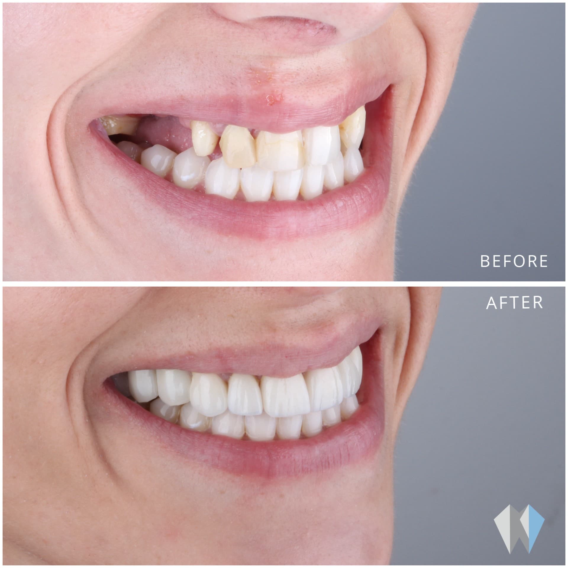 Before and after comparison of a smile showing dental restoration with straight, bright white teeth.